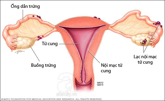 Lạc nội mạc tử cung là bệnh gì? Có nguy hiểm không?