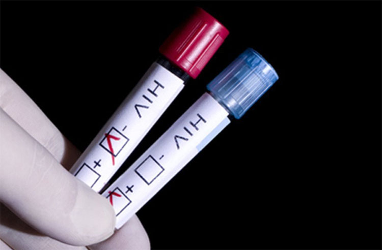 Kinh nghiệm đi làm xét nghiệm HIV bạn cần biết