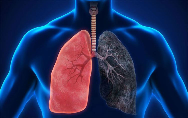 Tại sao ung thư phổi nguy hiểm?