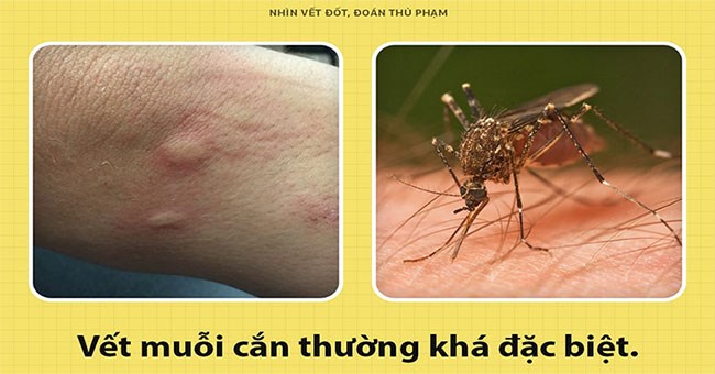Đọc luôn để nắm được cách "soi" vết cắn, biết ngay con gì đốt
