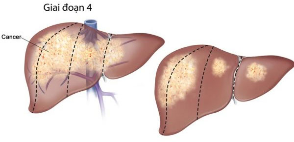 Xơ gan có mấy giai đoạn? Xơ gan cấp độ f1, f2, f3, f4 là gì?