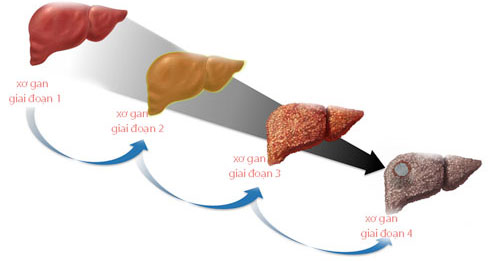 Xơ gan có mấy giai đoạn? Xơ gan cấp độ f1, f2, f3, f4 là gì?