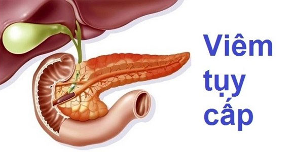 Viêm tuỵ cấp: Triệu chứng, phương pháp điều trị và cách phòng tránh