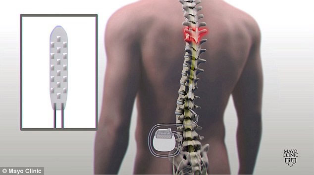 Đột phá y học: Lần đầu tiên bệnh nhân liệt cột sống có thể đi lại