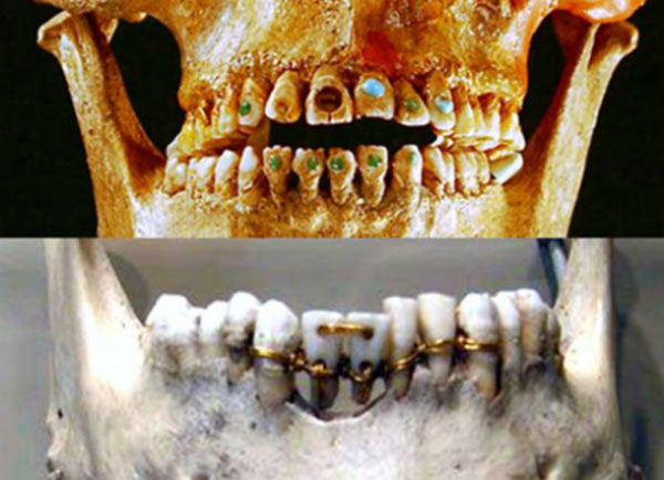 Người cổ đại trồng răng nâng mũi như thế nào?