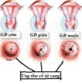 Mỹ mở rộng phạm vi sử dụng vắc xin ngừa ung thư và các bệnh liên quan đến HPV