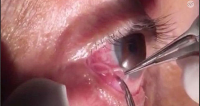 Rùng mình cảnh bác sĩ “bắt” giun ký sinh khỏi mắt người