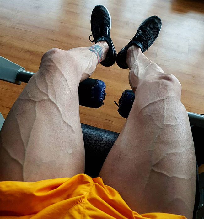 Đây là lý do một số người có làn da nổi gân guốc nhiều hơn hẳn phần còn lại