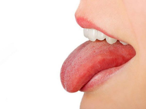 Biểu hiện của ung thư lưỡi có nhiều điểm rất tương đồng với bệnh nhiệt miệng.
