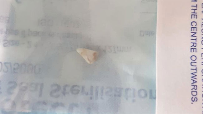 Chiếc răng nanh như Dracula trong miệng em bé 11 tuần tuổi