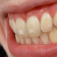 Răng của bạn có đốm trắng kỳ lạ này? Đây là lý do chúng xuất hiện