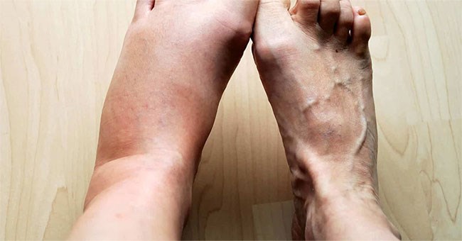 Tại sao cơ thể lại sưng khi bị viêm?