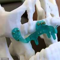 Ca phẫu thuật ghép xương hàm in 3D đầu tiên trên thế giới