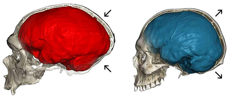 Những người đầu hơi bẹp là do gene di truyền của người Neanderthal