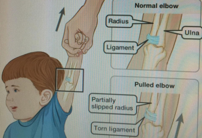 Kéo giật tay trẻ đột ngột dễ làm trật khớp khuỷu