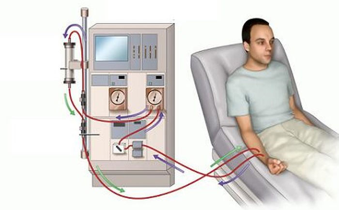 Quy trình chạy thận nhân tạo