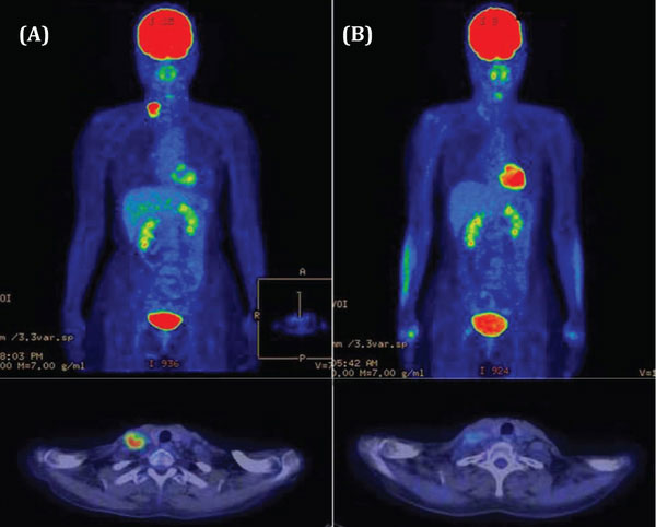 Chụp PET/CT là gì?