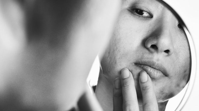 Chuyên gia Mỹ: Người có mụn trứng cá sẽ có điểm số cao và thành công trong cuộc sống