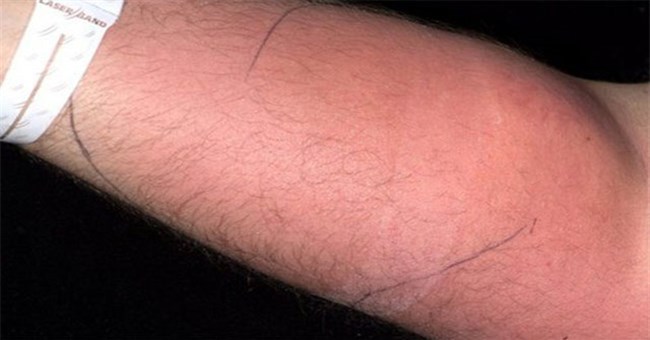 Lần đầu tiên trong lịch sử: Người đàn ông tự tiêm tinh trùng vào tay mình, ngay lập tức nhập viện