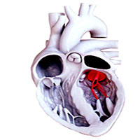 Lần đầu tiên trên thế giới, thay van tim không cần phẫu thuật mở