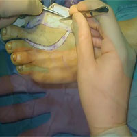 Việt Nam thực hiện thành công phẫu thuật siêu khó: lấy ngón chân cái thay cho ngón tay cái