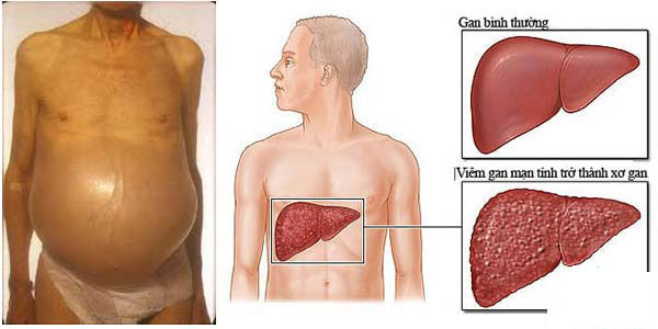 Xơ gan cổ trướng là gì? Triệu chứng, chẩn đoán và điều trị