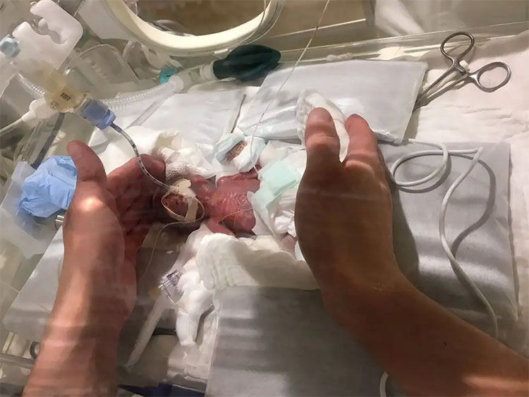 Cậu bé nhỏ nhất thế giới: 268g vẫn sống sót!