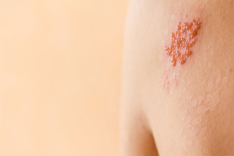 Bệnh zona thần kinh - Triệu chứng, nguyên nhân và cách điều trị