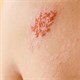 Bệnh zona thần kinh - Triệu chứng, nguyên nhân và cách điều trị