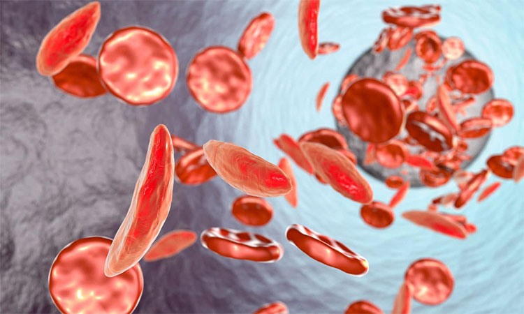 Cấy virus HIV vào tủy để cứu những bệnh nhân chết dần chết mòn vì nghẹt thở