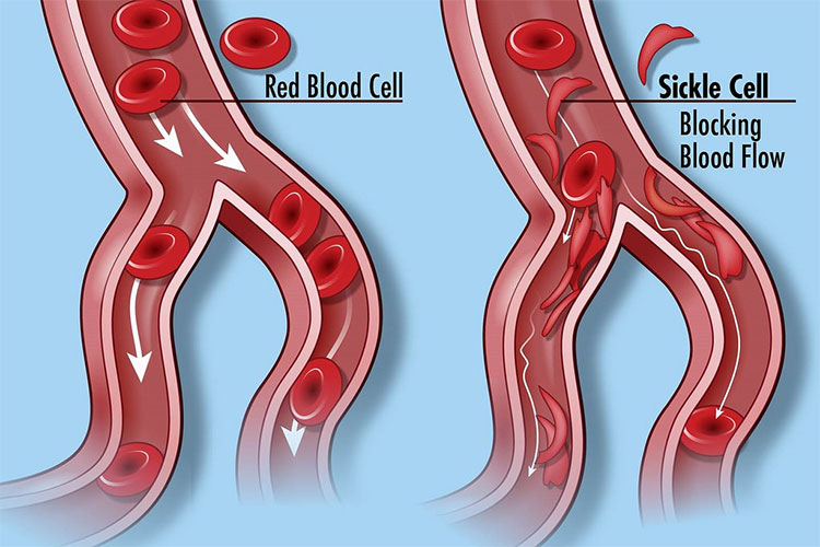 Cấy virus HIV vào tủy để cứu những bệnh nhân chết dần chết mòn vì nghẹt thở
