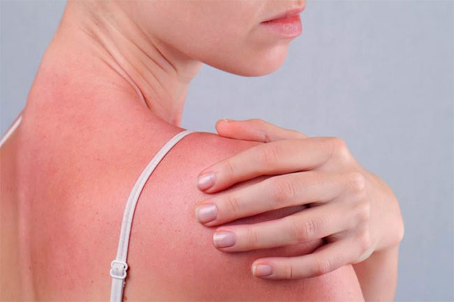 Ngộ độc ánh nắng mặt trời - tình trạng nguy hiểm cần được nhận biết ngay