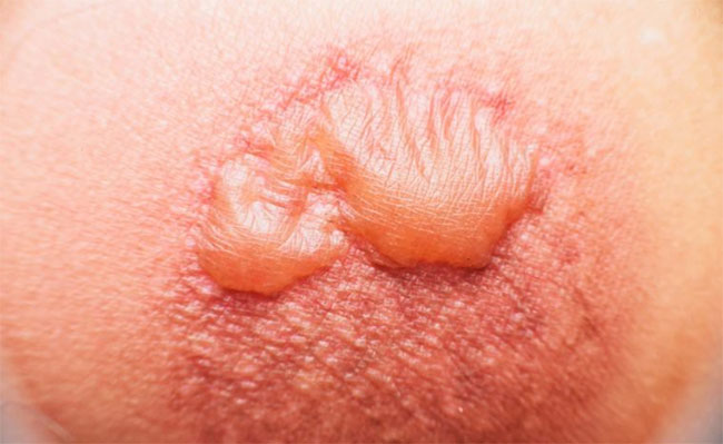 Ngộ độc ánh nắng mặt trời - tình trạng nguy hiểm cần được nhận biết ngay