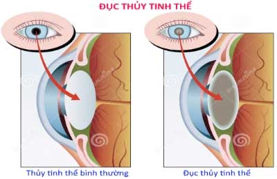 Kính râm, dùng sao cho lợi?