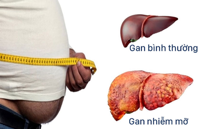 Gan nhiễm mỡ: Nguyên nhân, triệu chứng và cách điều trị