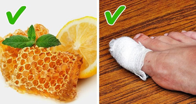 Những cách tự nhiên chữa móng chân mọc lệch đâm vào da thịt