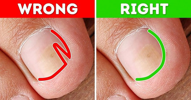 Những cách tự nhiên chữa móng chân mọc lệch đâm vào da thịt