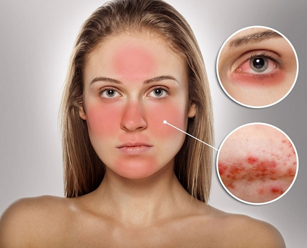 Những bệnh về da dễ mắc trong nắng nóng mùa hè