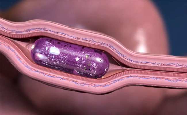 Công nghệ tiêm không đau