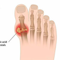 Bệnh Gout: Nguyên nhân, triệu chứng và cách điều trị