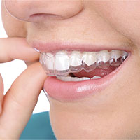 Những điều chưa biết về niềng răng trong suốt Invisalign