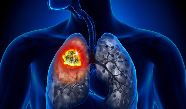 Những loại ung thư có tính di truyền qua nhiều đời mà bạn nên nắm rõ