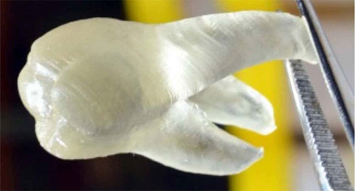 Rút ngắn thời gian trồng răng giả nhờ chân răng 3D