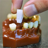 Rút ngắn thời gian trồng răng giả nhờ chân răng 3D