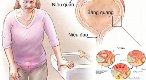 Đau bụng dưới bên trái dấu hiệu bệnh gì?