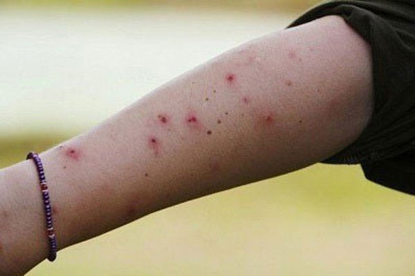Nguyên nhân nổi mề đay không phải ai cũng biết