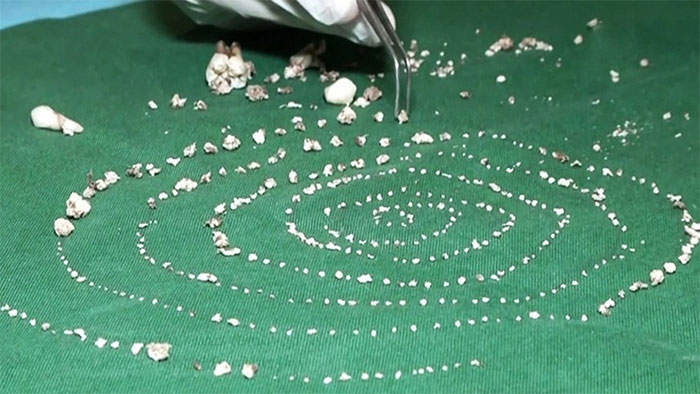 Tại sao bé 7 tuổi có đến 526 chiếc răng?