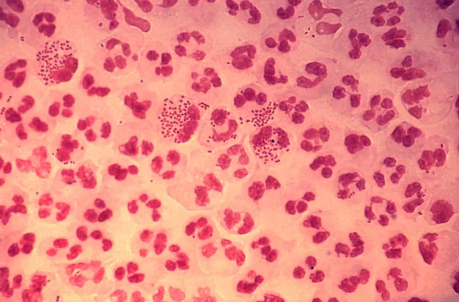 Vi khuẩn Neisseria gonorrhoeae gây ra bệnh lậu.