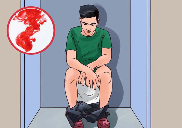 3 dấu hiệu mà nhiều người thường nhầm lẫn giữa bệnh ung thư ruột và bệnh trĩ