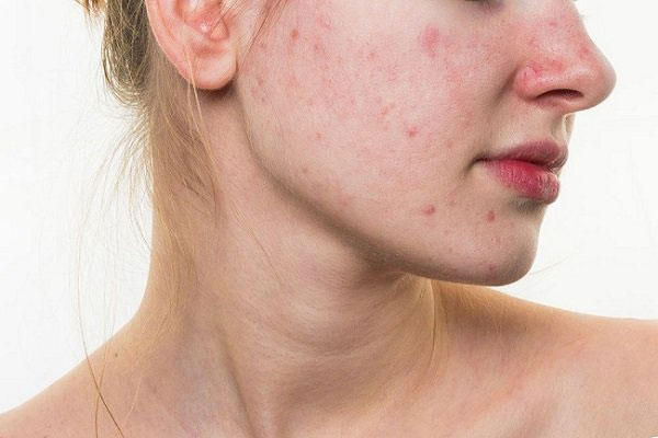 Cách xử lý khi bị dị ứng da mặt